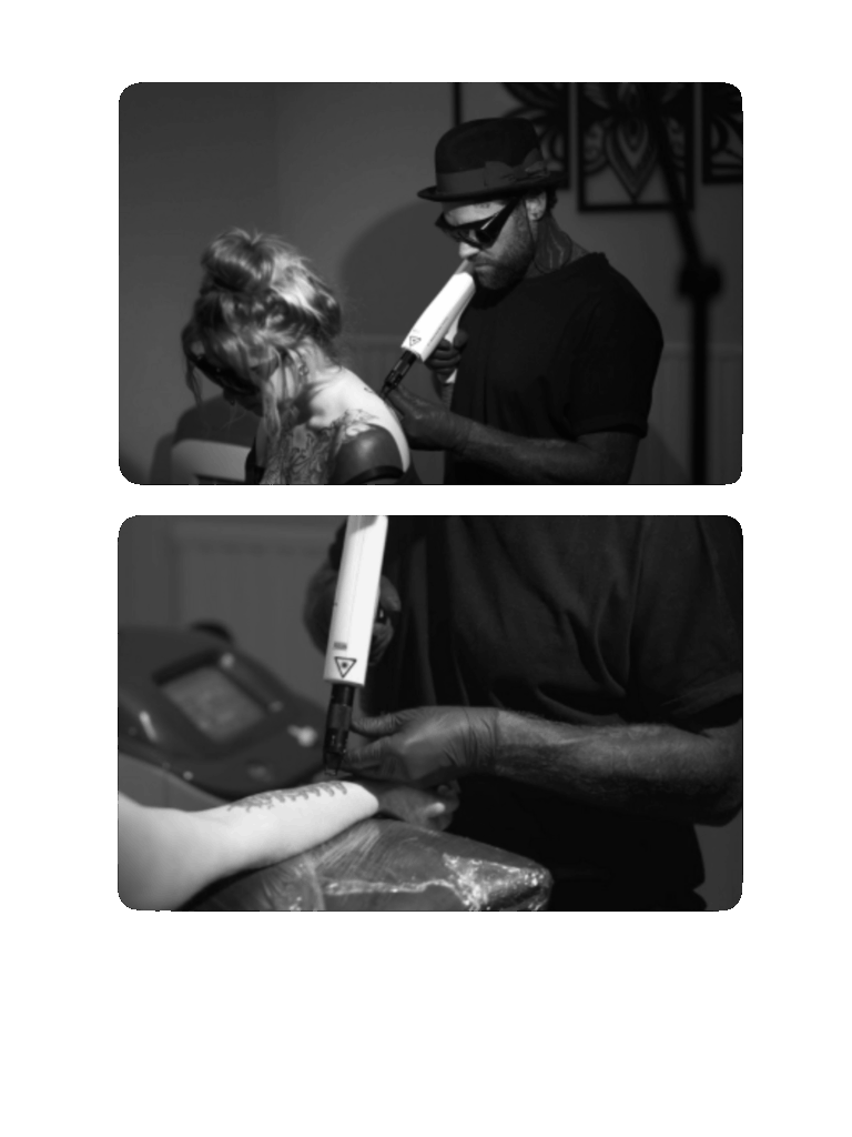 Lserborttagning Laser Tatueringsborttagning